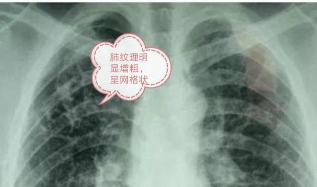 肺纹理紊乱图片