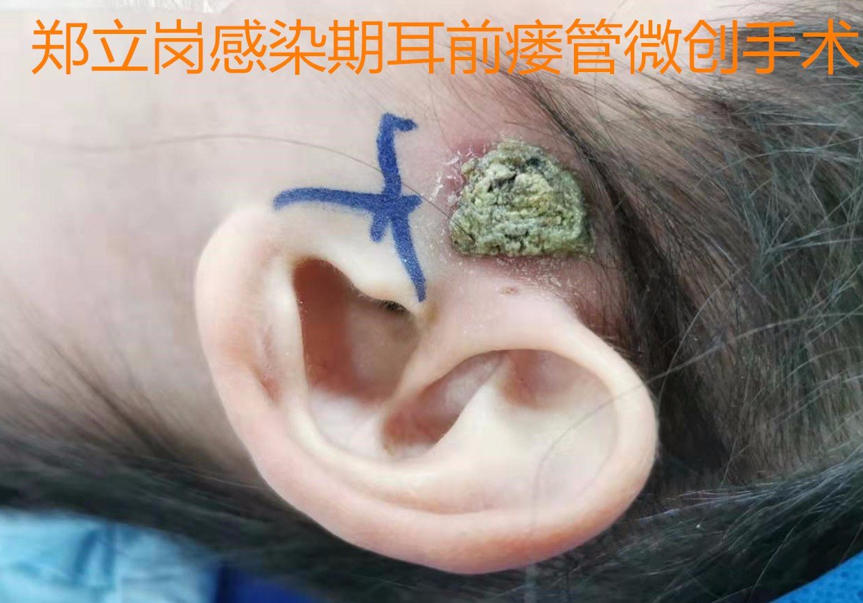 耳前瘘管盲端图片