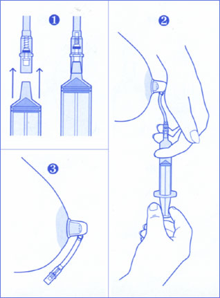 多用吸奶器吸引或注射器抽吸(图5-1-2).