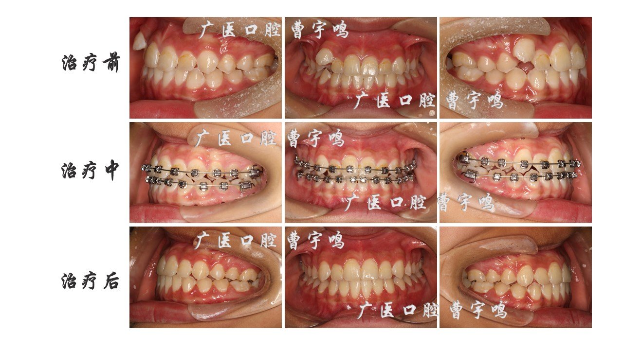 虎牙外凸严重矫正图图片