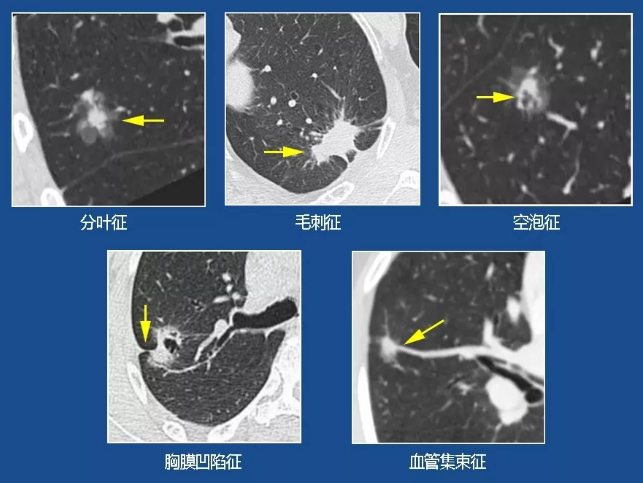 毛刺征,空泡征,胸膜凹陷征及血管集束征,或者在随访观察过程中,有结节