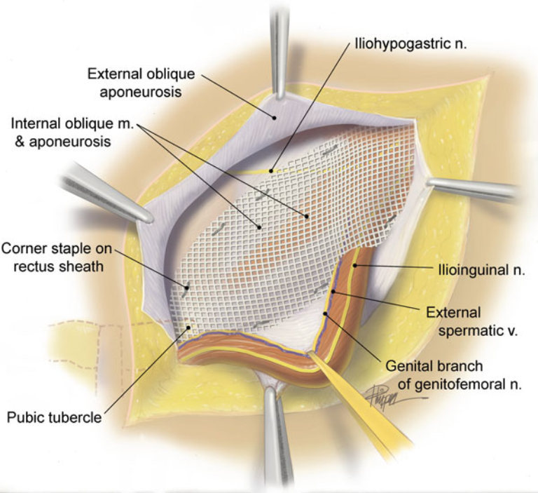 手术单纯修补 张力疝修补术式——多用于急诊 平诊已废弃补片修补术