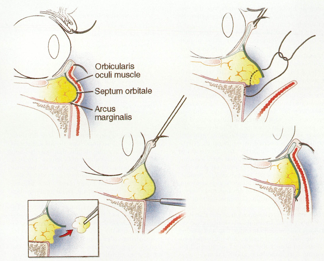 眶隔脂肪释放术的原理和历史