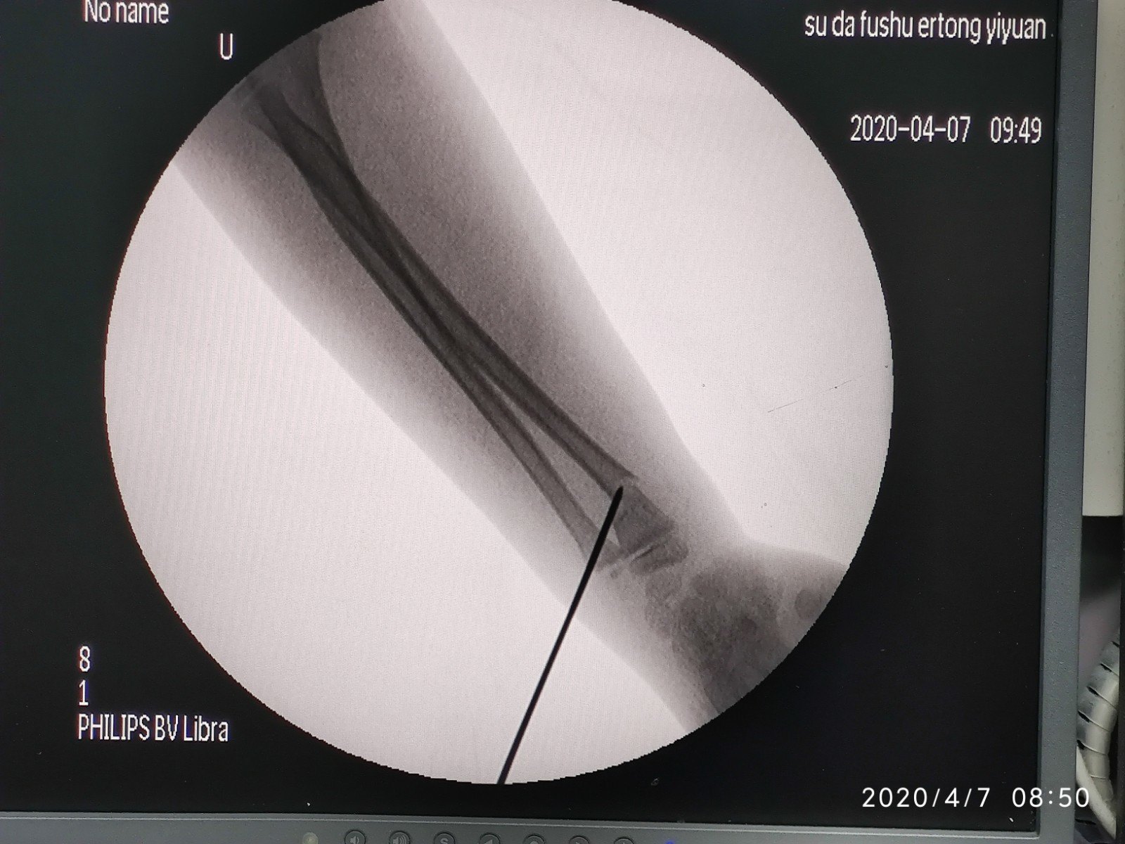 兒童尺橈骨遠端骨折的微創治療技術