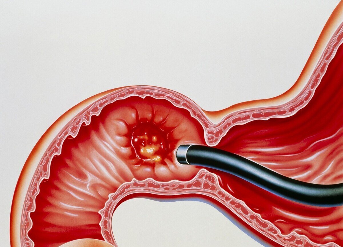 打嗝有时候竟然是肿瘤的表现,在众多病因中,肿瘤性打嗝什么表现_症状