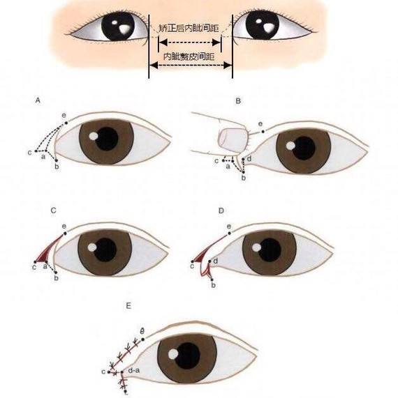 开内眼角原理图片