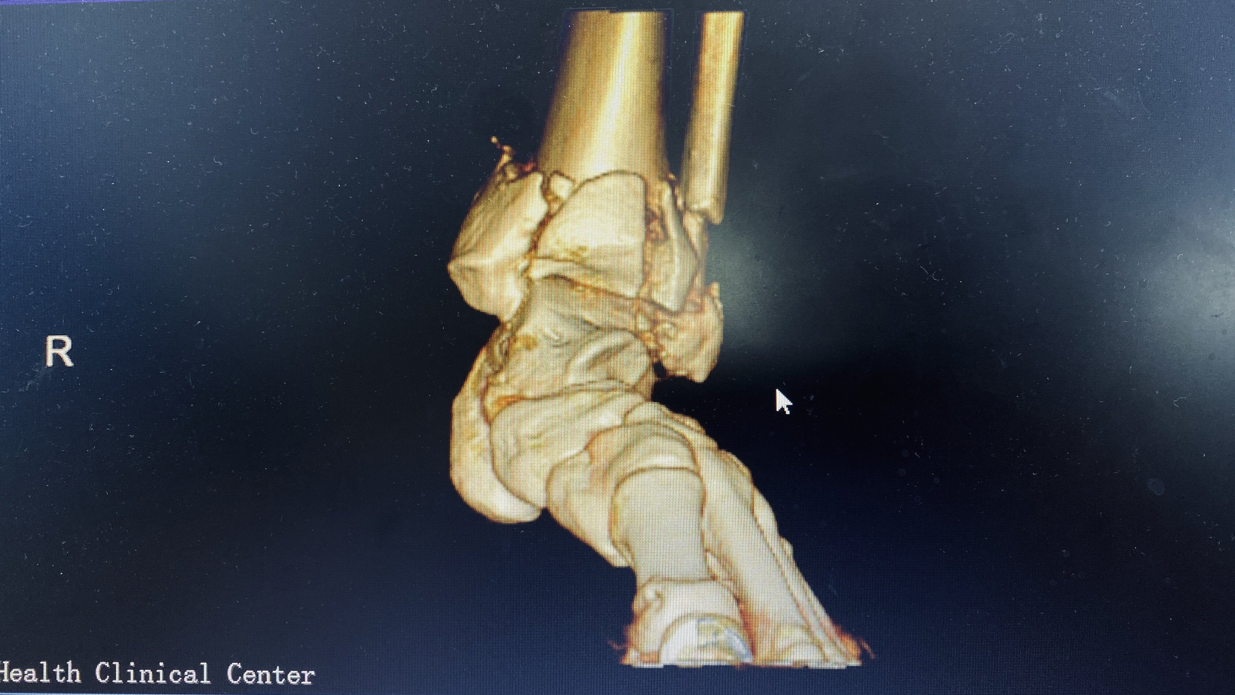 pilon骨折的完美治疗 - 好大夫在线