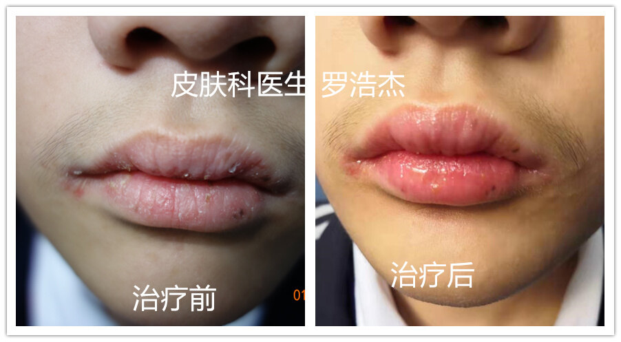 haodf:8:chunyan--> !--haodf:8:chunyan-->唇炎 !