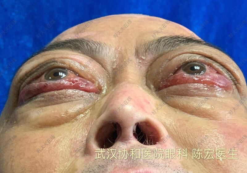 极重度甲状腺相关眼病