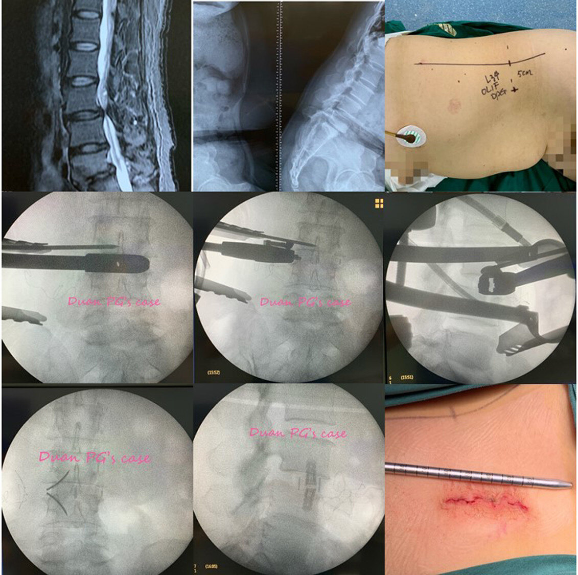 腰椎滑脱手术过程图片图片