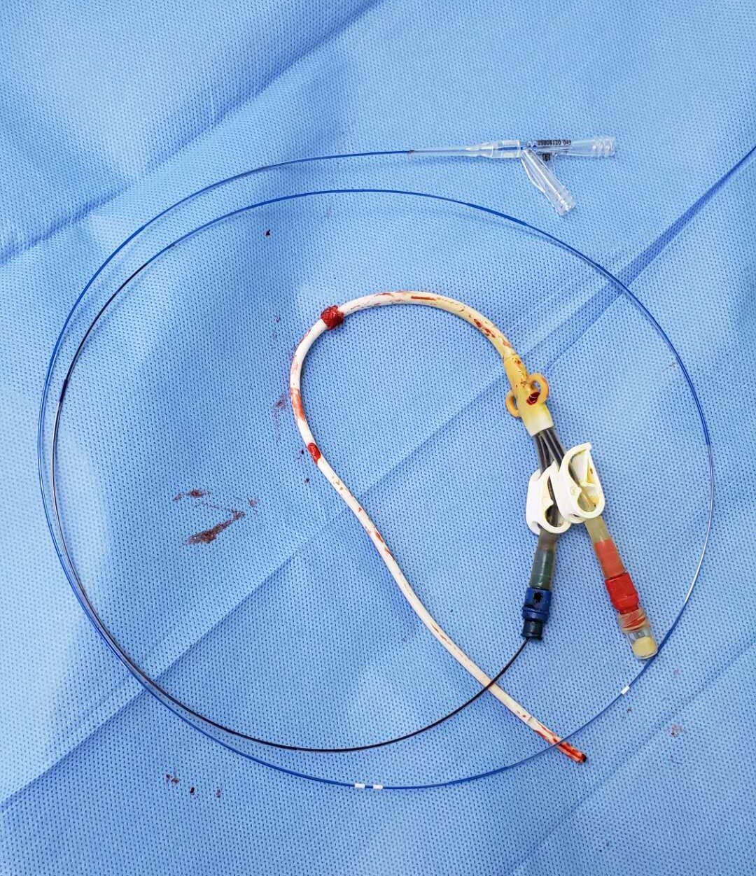 一例植入10年的颈内静脉透析导管拔除 