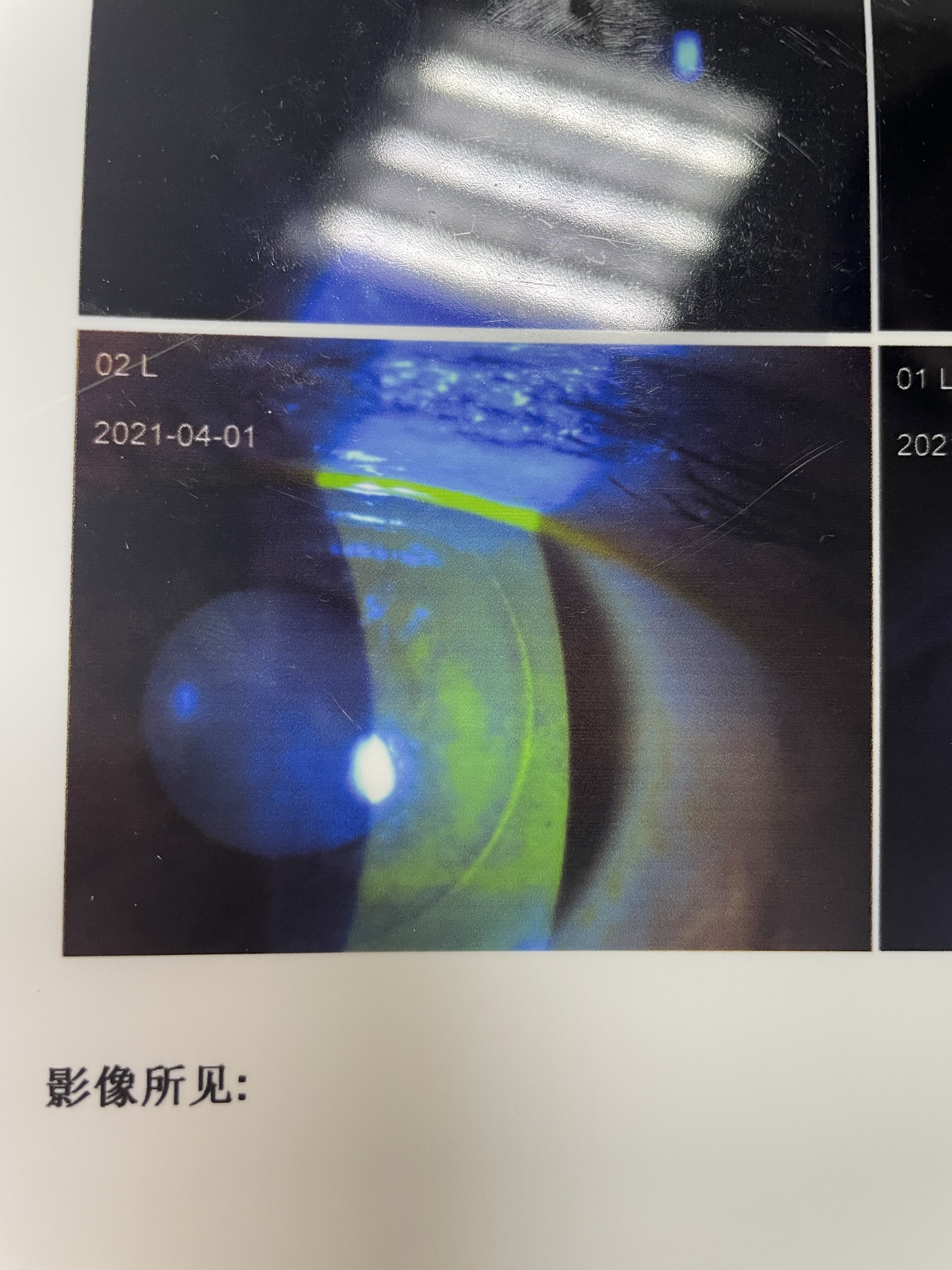 青光眼斑图片图片