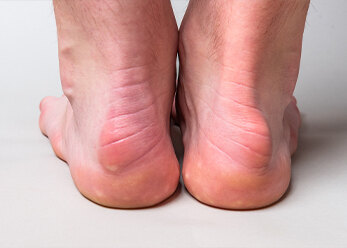 足跟后方凸起伴疼痛小心跟腱被骨头磨坏