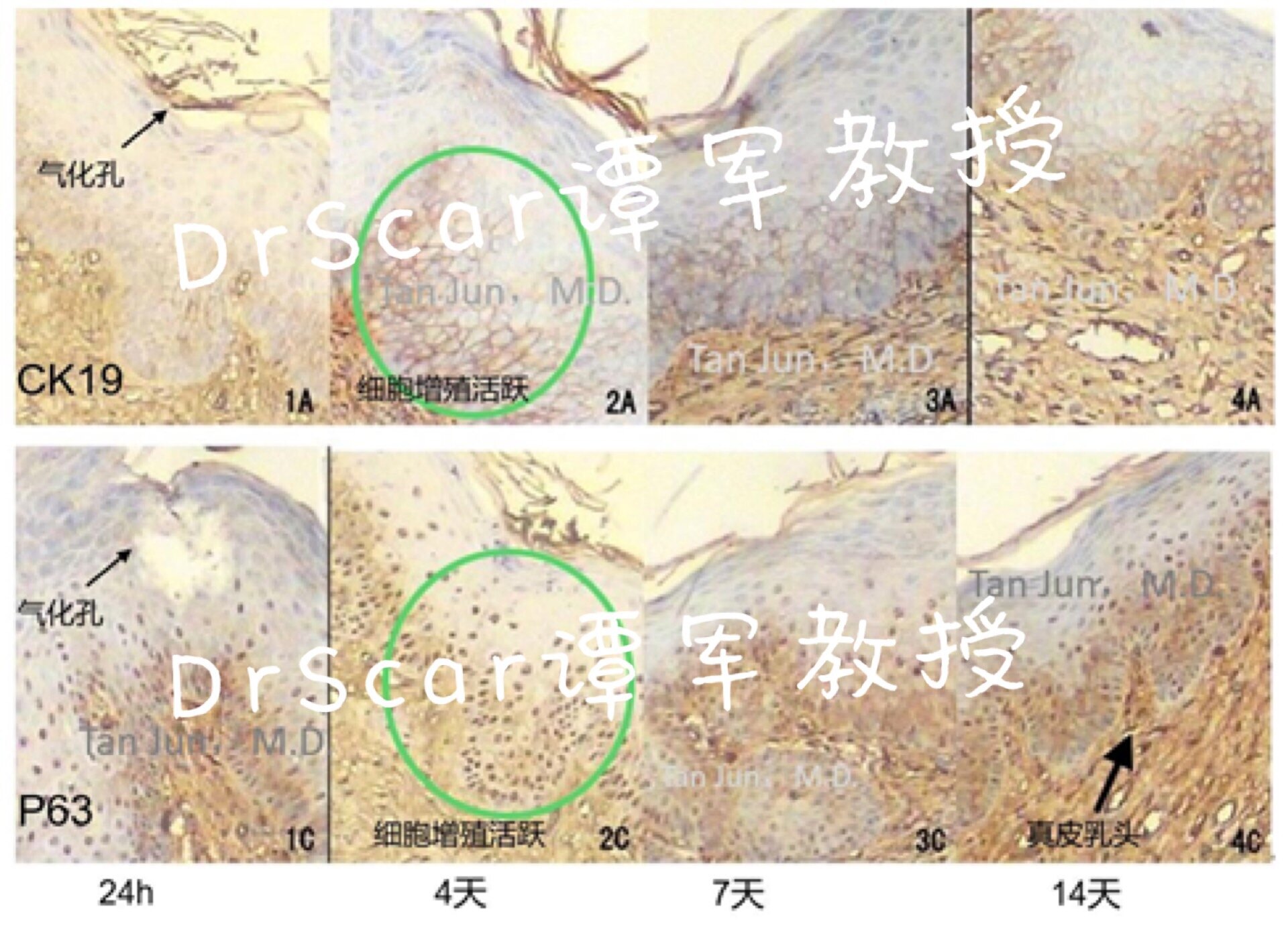 点阵co2激光修复瘢痕原理二