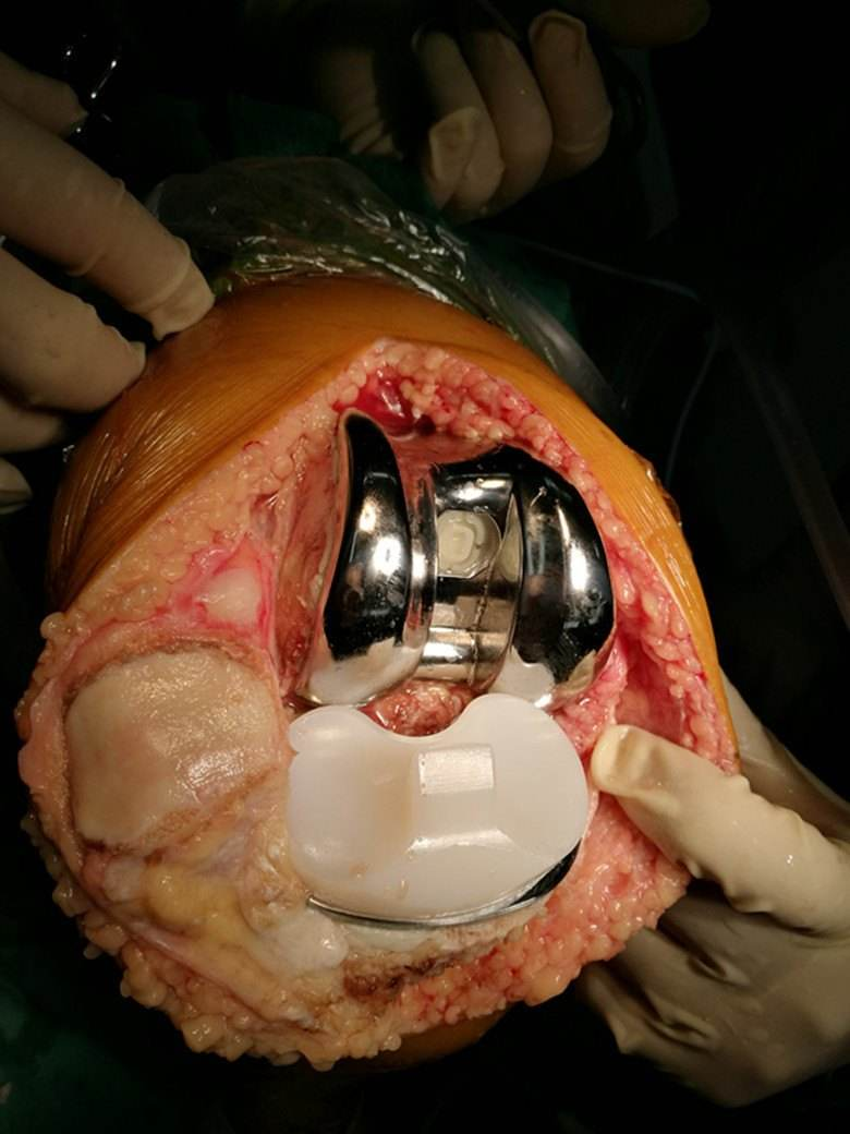 全膝关节置换术tka晚期膝关节病变的终极而无奈的选择