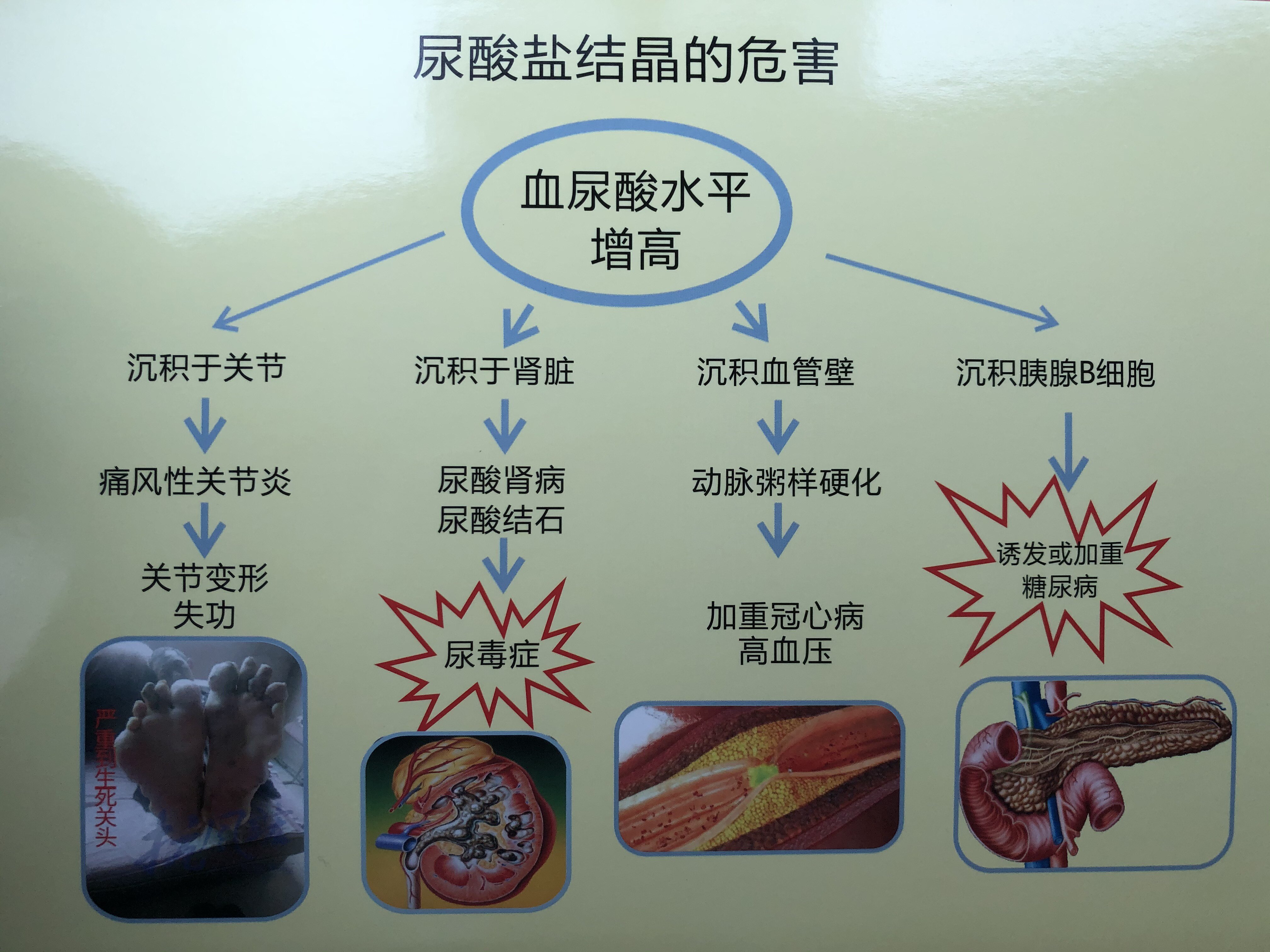 痛风有哪些并发症