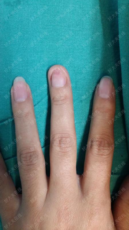 指甲整形_整形 - 好大夫在线
