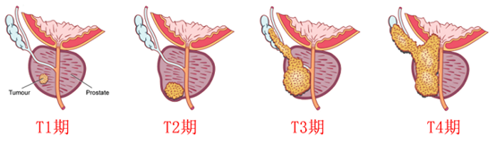 前列腺癌科普系列之三前列腺癌的手术治疗