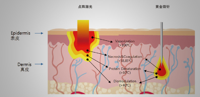 9黄金微针和点阵激光对比.png