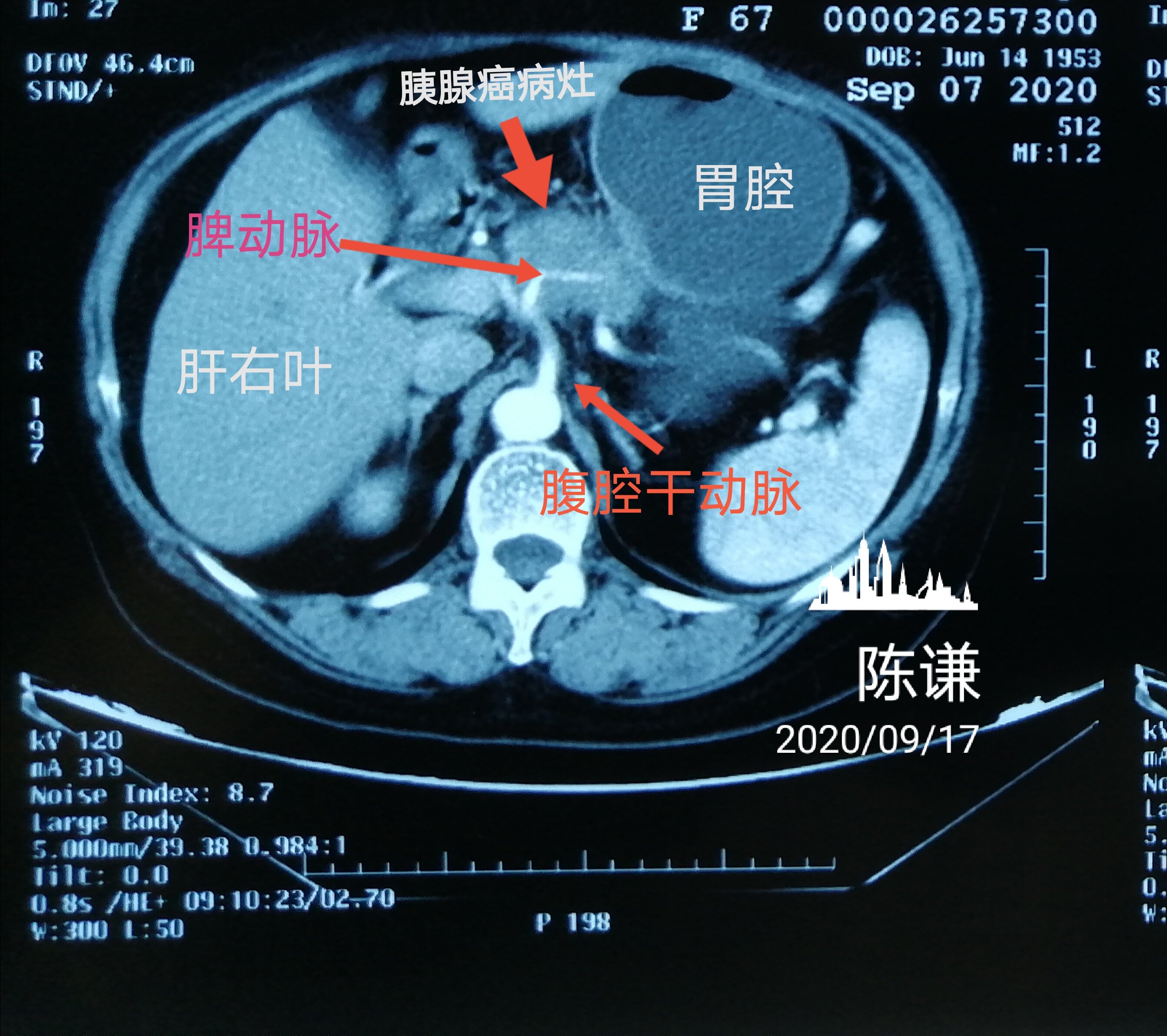 胰腺癌的ct图片与报告图片