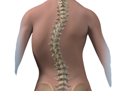如何纠正脊柱侧弯这几个方法最靠谱