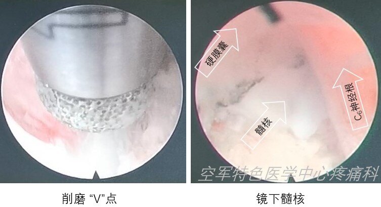 削磨及髓核.jpg