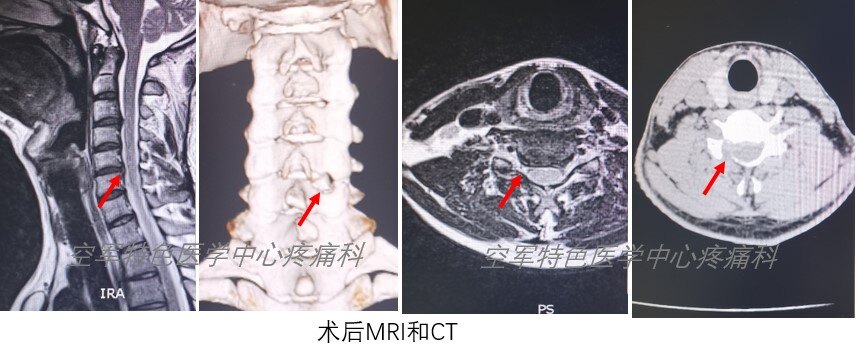 术后MRI与CT.jpg