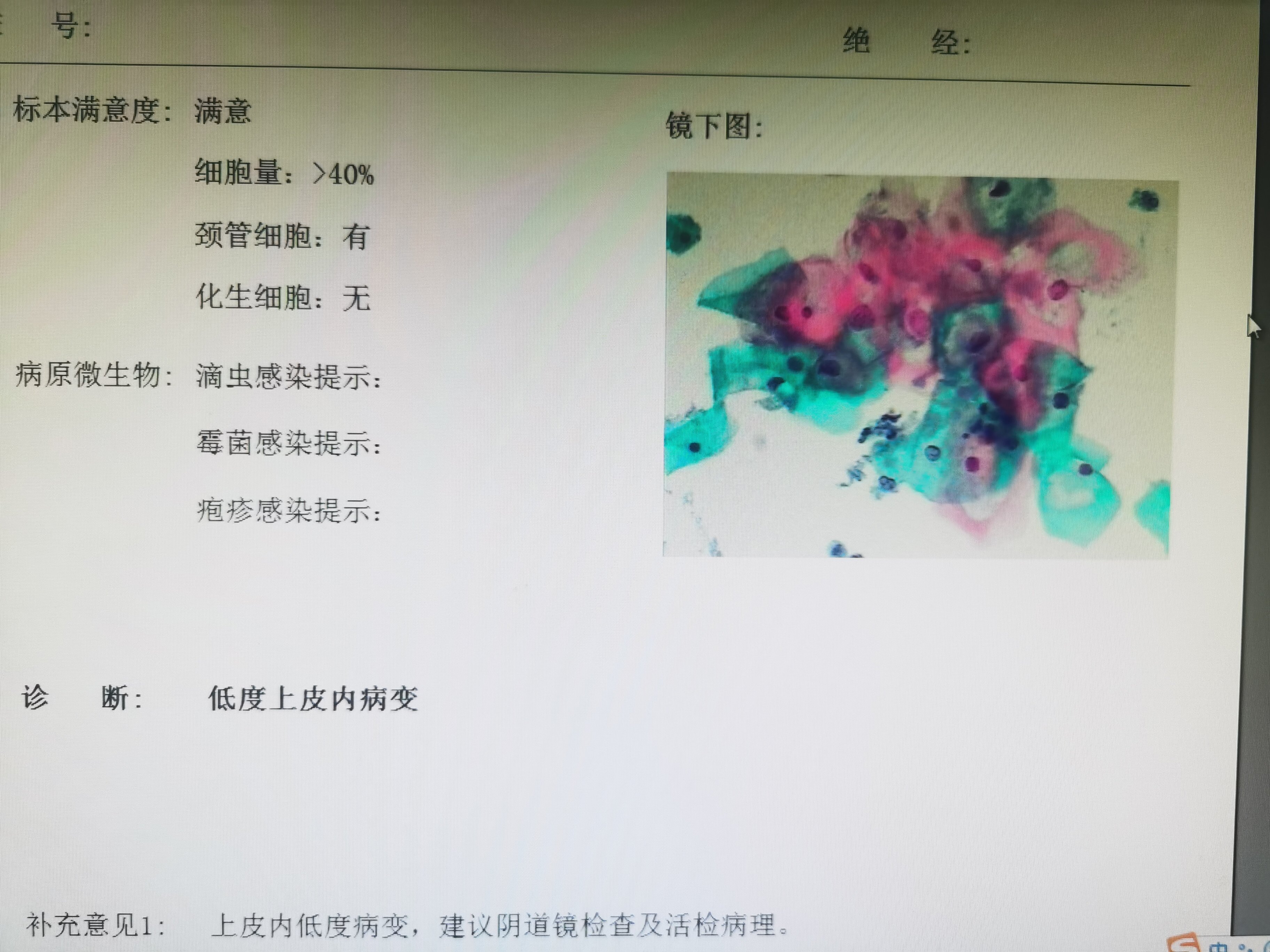 一分钟读懂宫颈液基细胞学tct报告