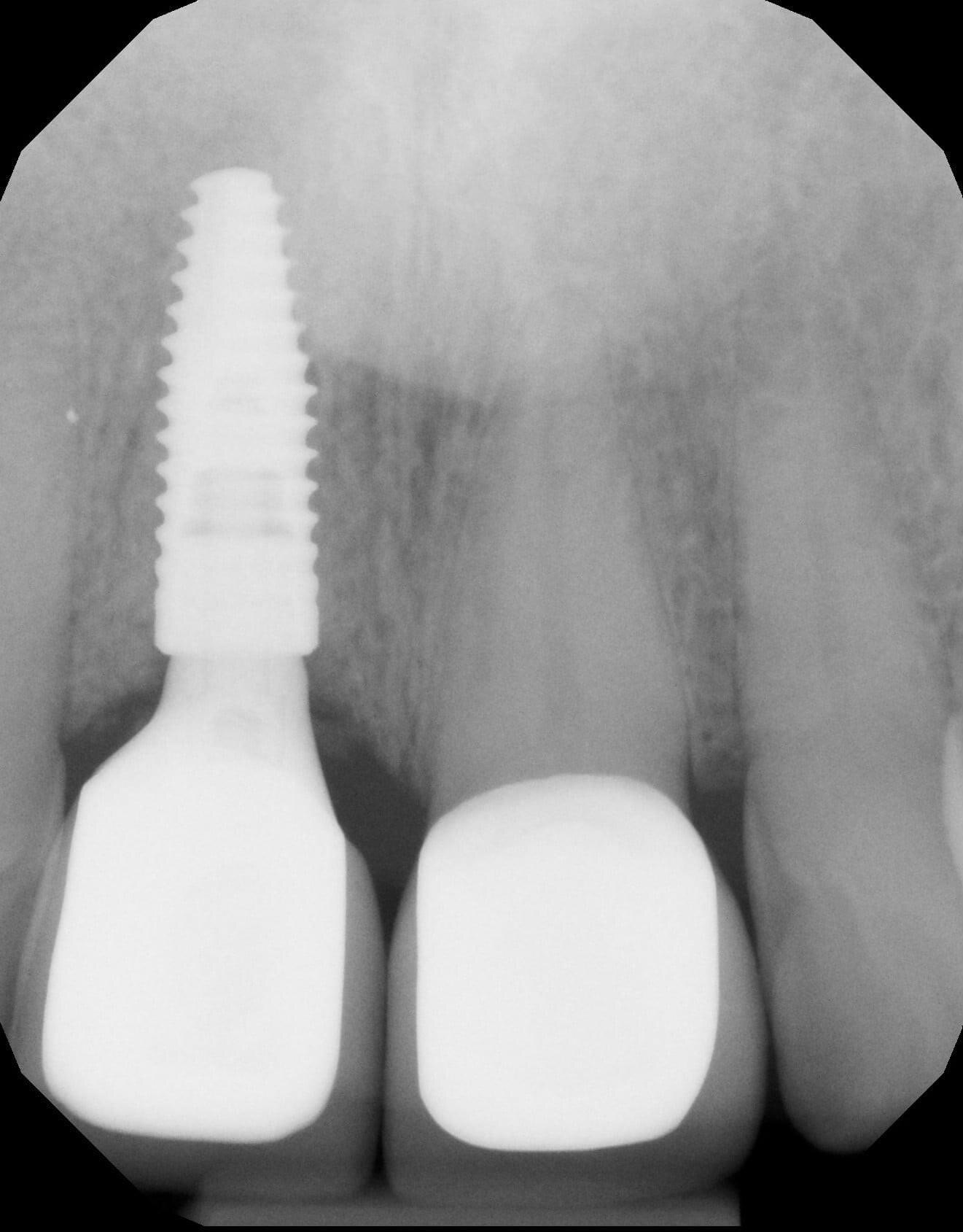 安装结束后拍摄的牙片,可见种植牙牙根的位置及骨愈合的情况