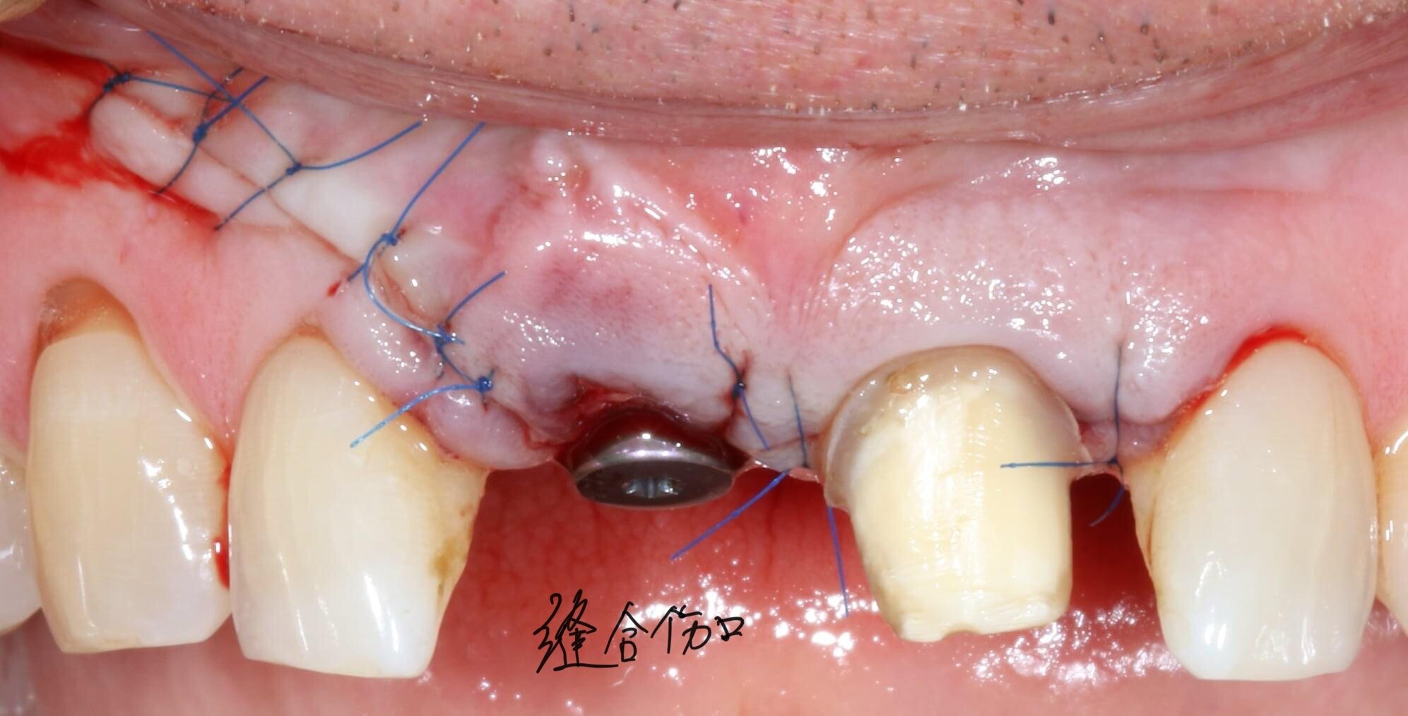 种植钻预备并植入种植体(种 植牙 牙的牙根,表面覆盖人工骨粉骨膜