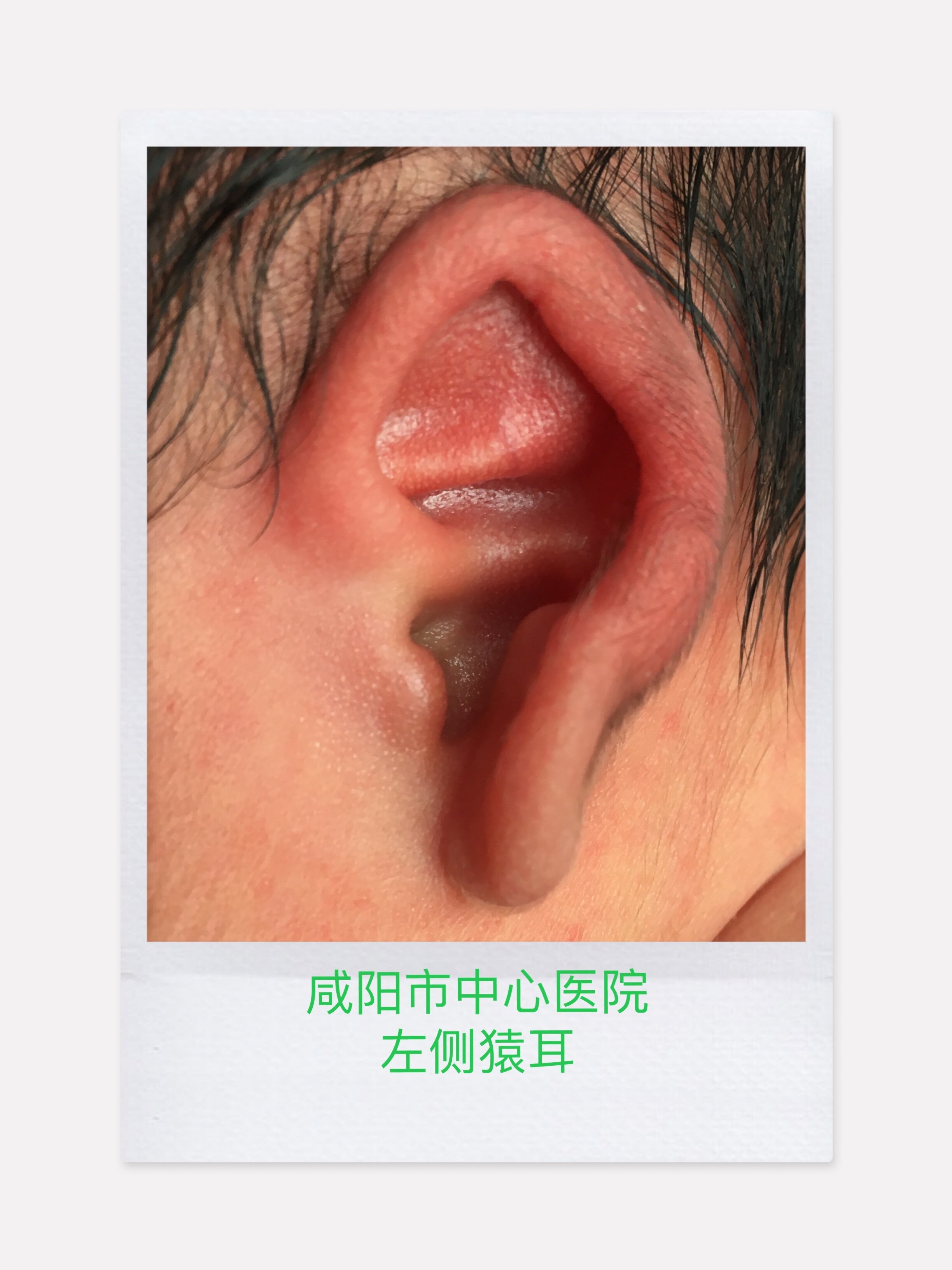 隐耳耳廓软骨上端隐入颞部头皮下,上方的颅耳沟变浅或消失,无明显的耳