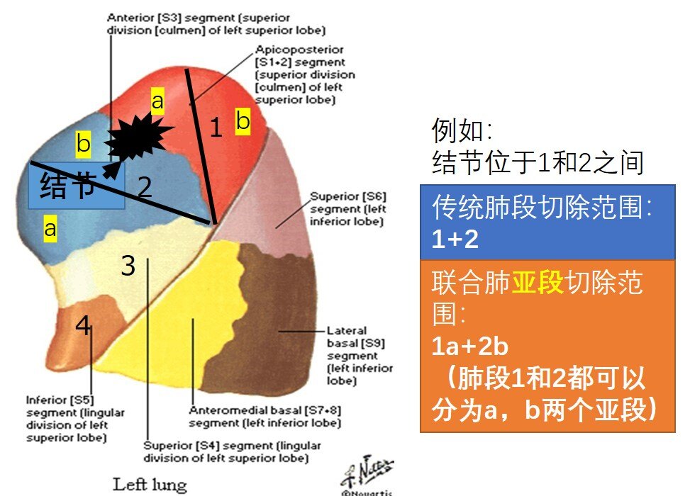 (1)韓醫生利用術前ct進行3d重建,確定需要切斷的氣管血管(2)確定好