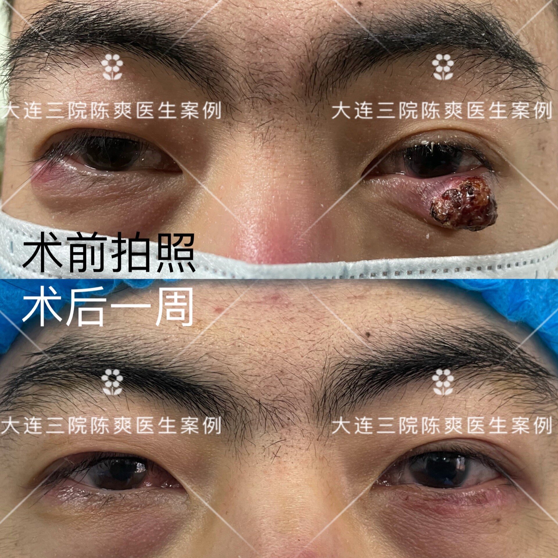 针眼并不可怕,选择正规医院,及时调理,规范治疗很重要.