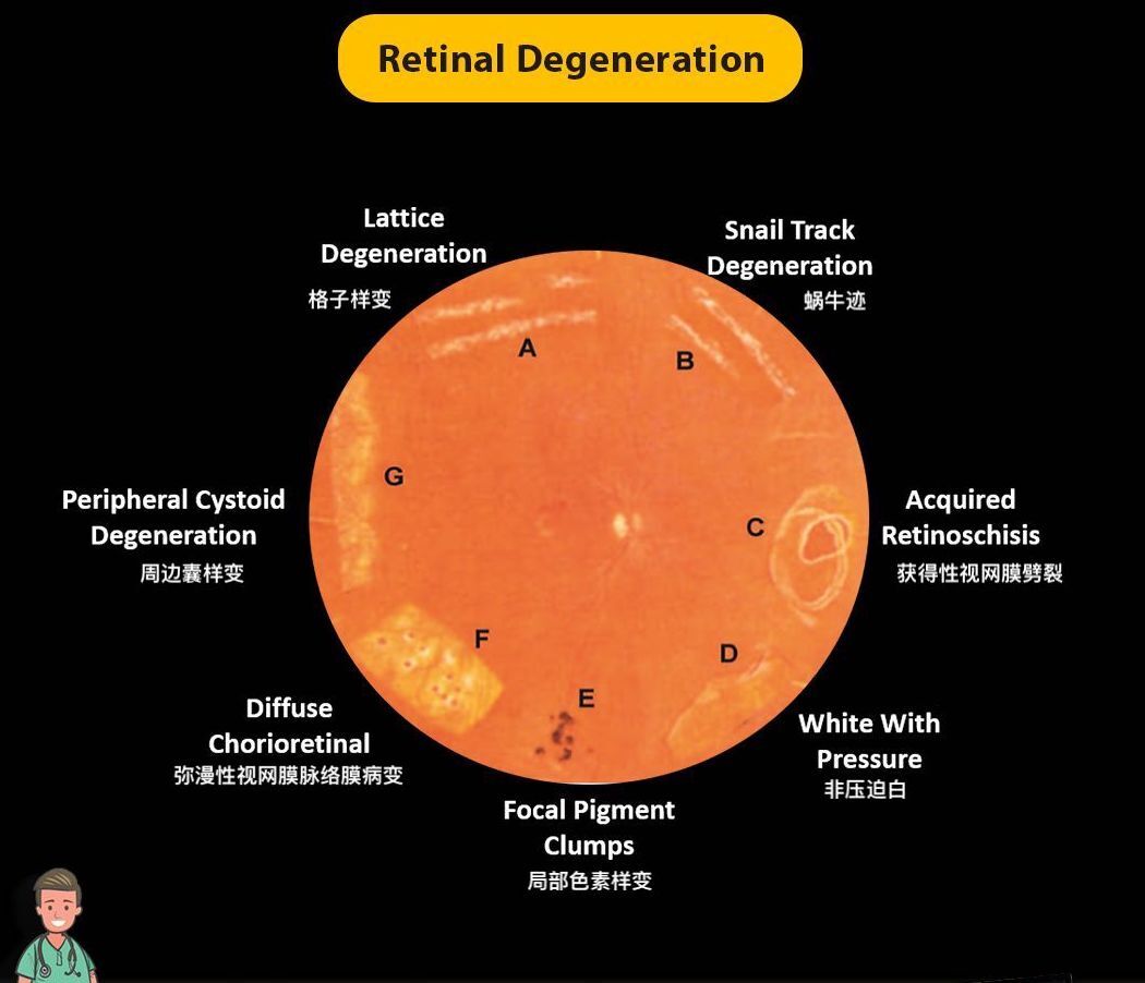 Lattice Degeneration.jpg