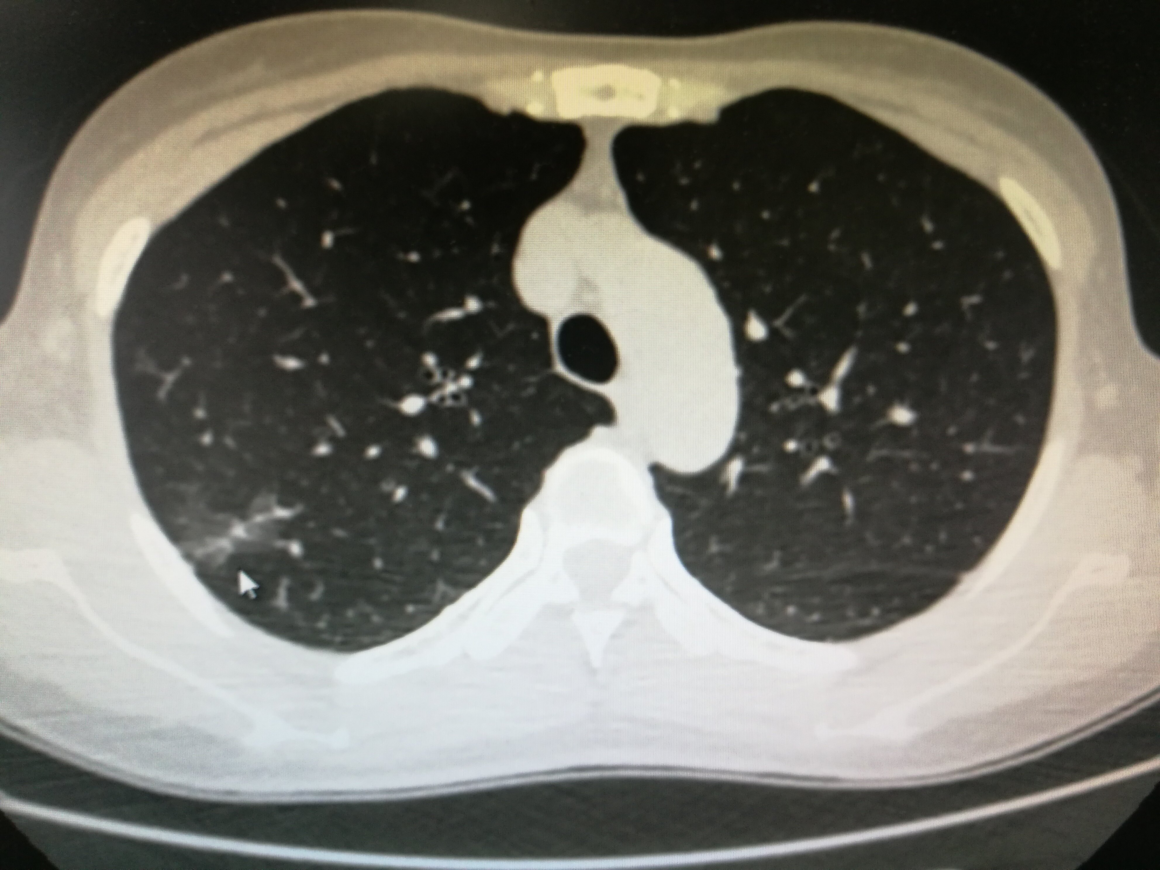 肺部结节 肺部结节