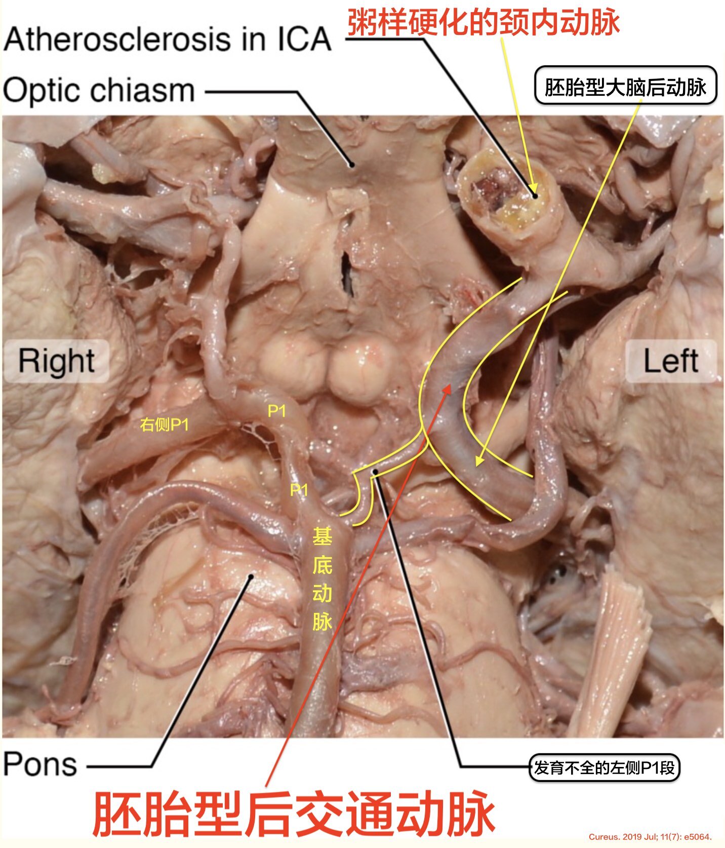 胚胎型大脑后动脉ppt图片