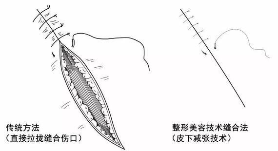 减张缝合拆线方法图解图片