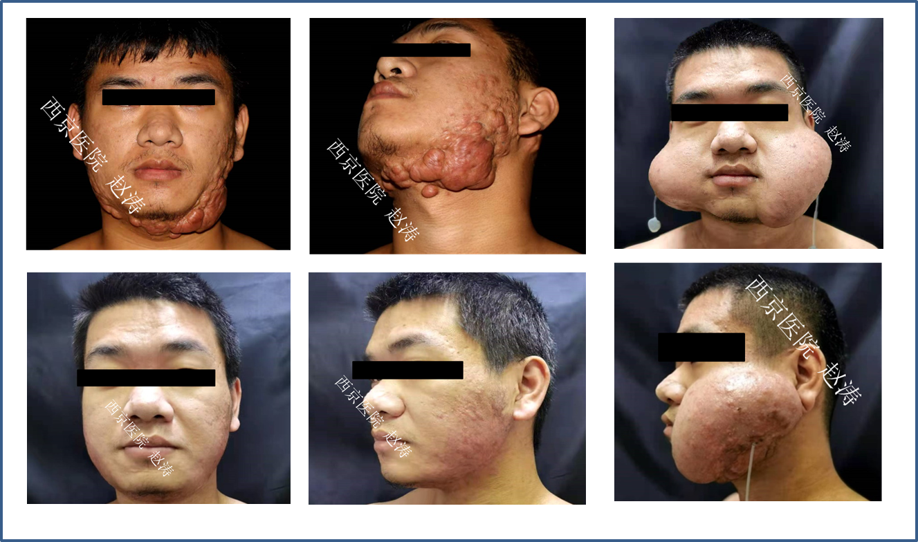 下颌瘢痕疙瘩 皮肤扩张术 放疗 - 好大夫在线