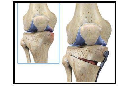 o型腿截骨手术图片图片