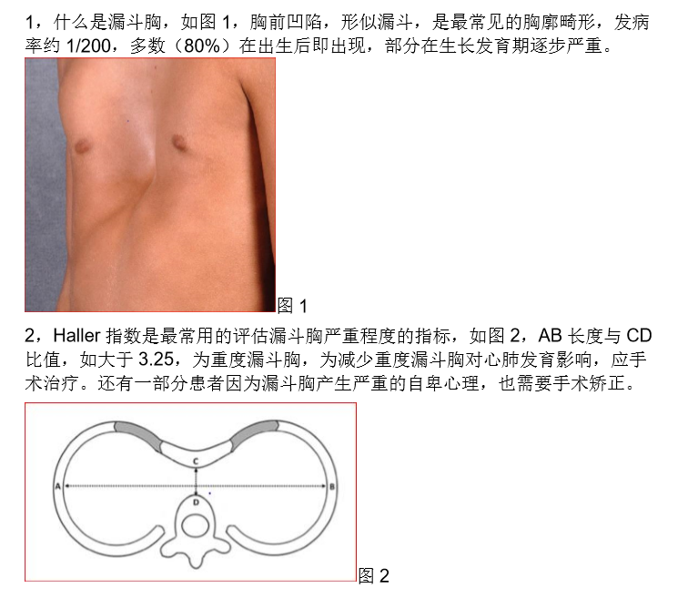 图解漏斗胸治疗 漏斗胸 漏斗胸