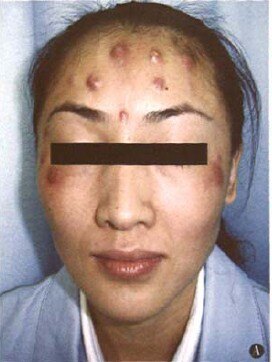 面部注射美容后感染——分枝杆菌感染_注射美容_注射美容治疗介绍