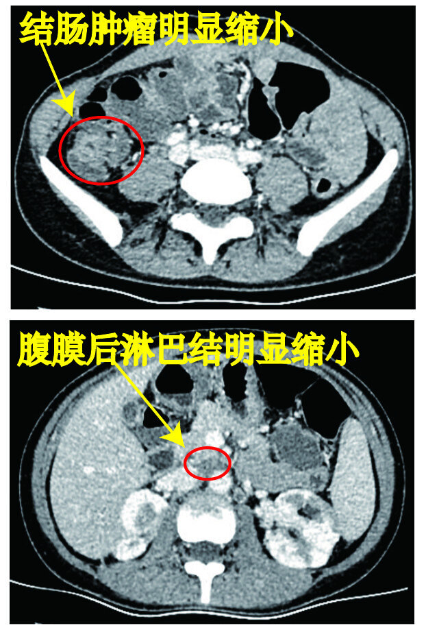 复查ct提示升结肠癌原发灶肿瘤和后腹膜肿大淋巴结都明显消退缩小,为