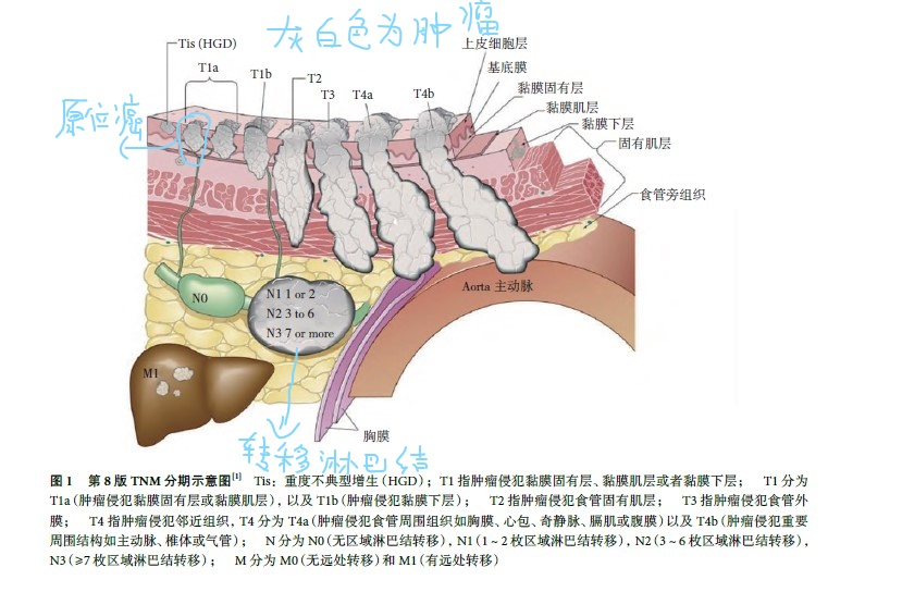 食管癌侵犯深度的分期彩图第8版食管癌分期tnm定义彩图 食道癌 食道癌