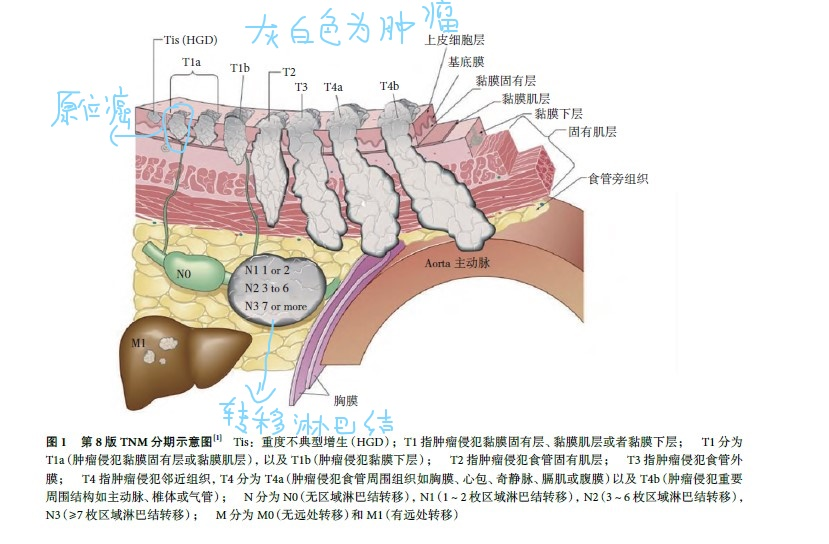 食管癌侵犯深度的分期彩图第8版食管癌分期tnm定义彩图 食道癌 食道癌 食管癌侵犯深度的分期彩图第8版食管癌分期tnm定义彩图 食道癌 食道癌