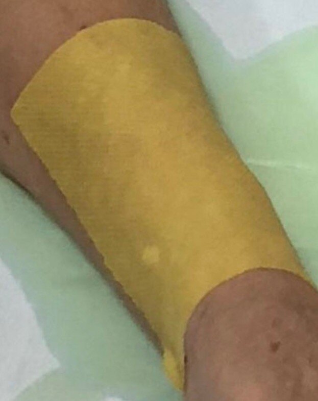 将浸透的纱布块,敷在红肿部位或者皮损的部位,每次敷10分钟左右,每日