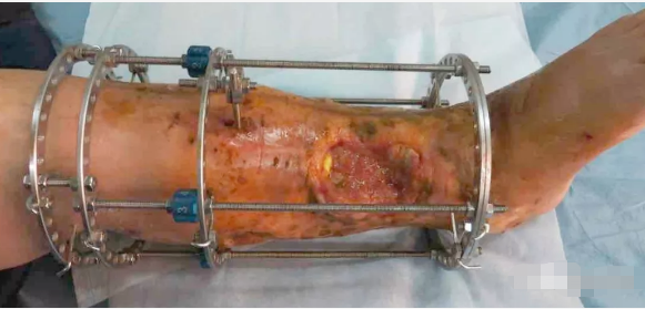 彻底清理病灶后遗留约5厘米骨缺损,安装外固定架,应用ilizarov骨搬运