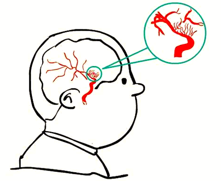 烟雾病会导致什么:烟雾病可能会导致脑出血,脑缺血,脑梗等