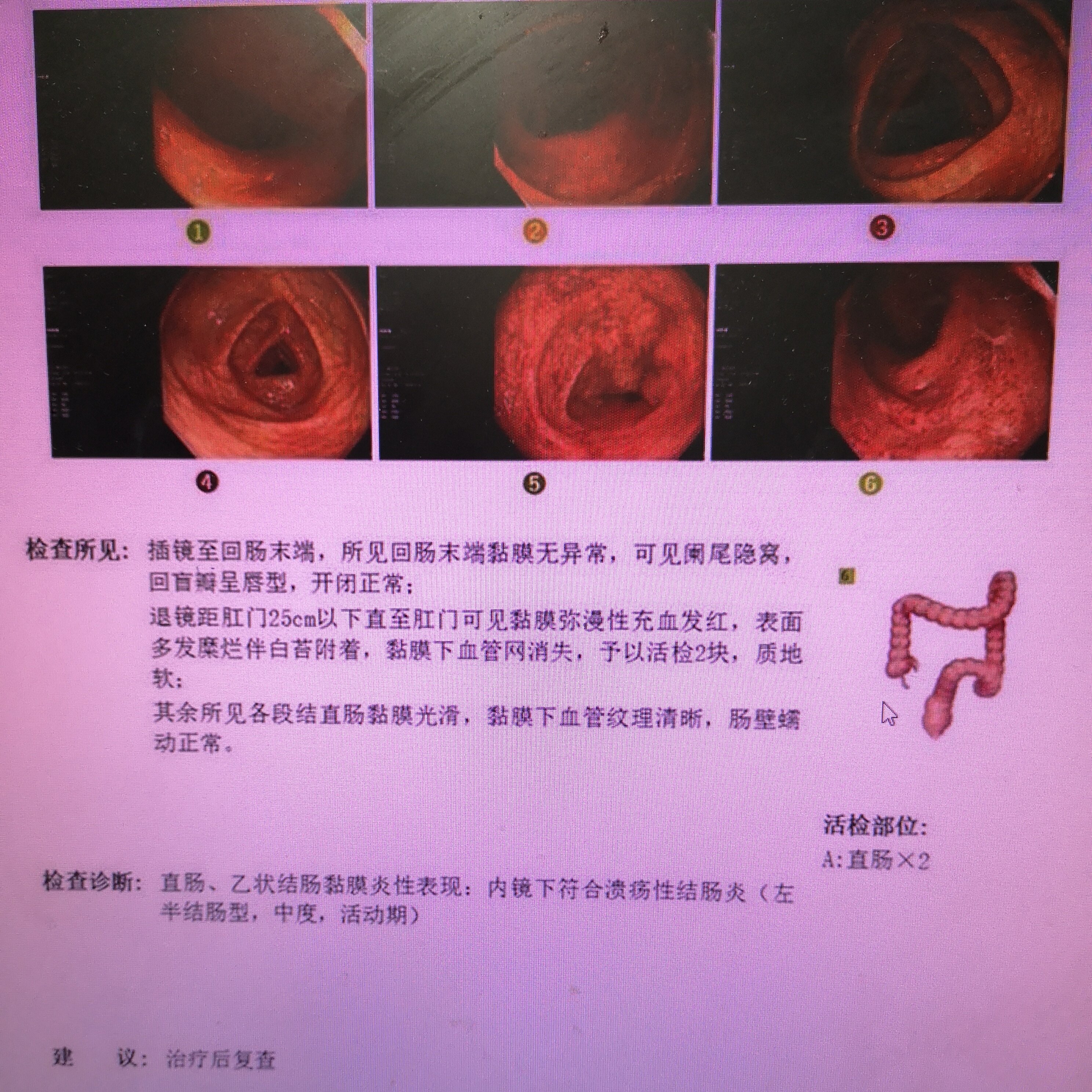 中醫不是慢郎中,特效中藥治療潰瘍性結腸炎的療效再證明!