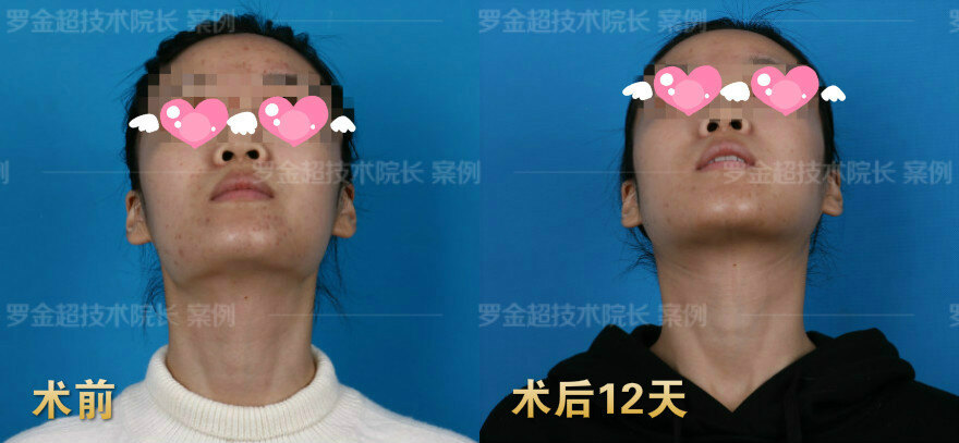 下颌角手术后多长时间可以上班