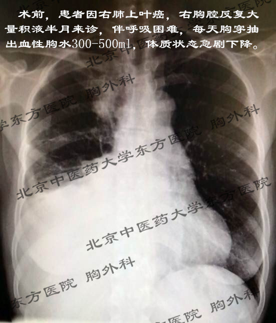 (2-2)北京东方医院胸外科采用胸腔镜微创手术根治顽固性恶性胸腔积液